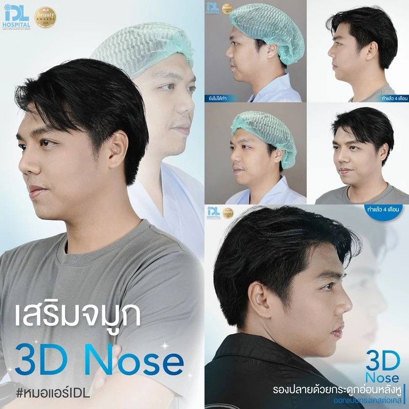 รีวิว เสริมจมูก IDL