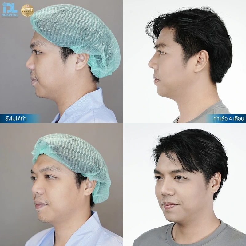รีวิว เสริมจมูก IDL