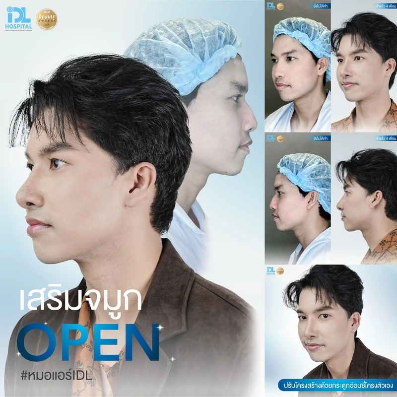 รีวิว เสริมจมูก Open IDL