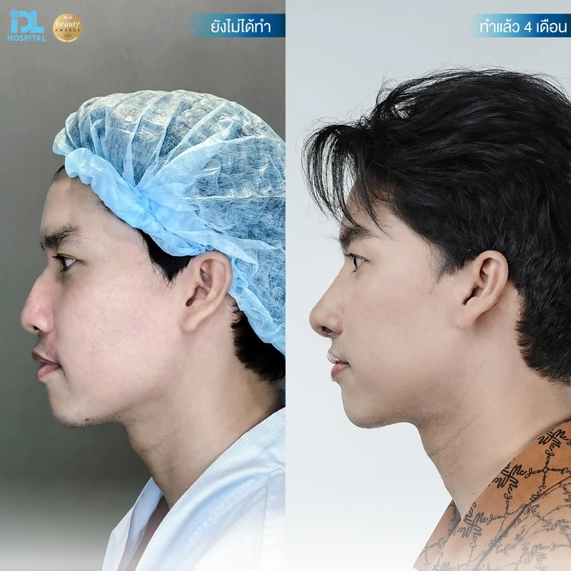 รีวิว เสริมจมูก Open IDL