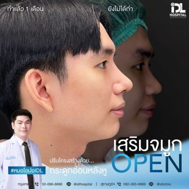 รีวิว เสริมจมูก Open IDL