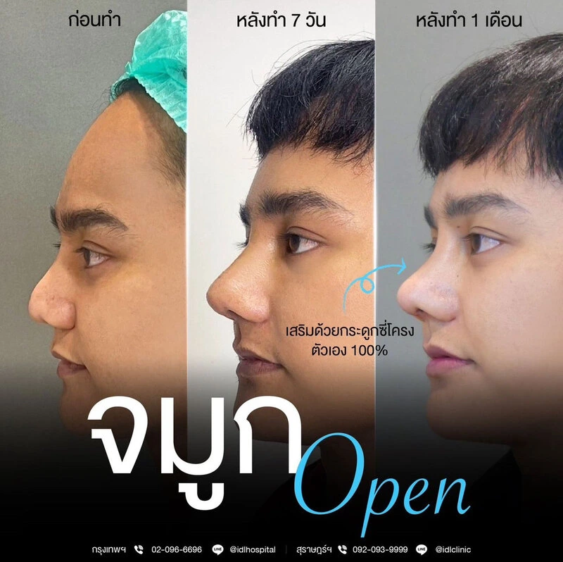 รีวิว เสริมจมูก Open IDL