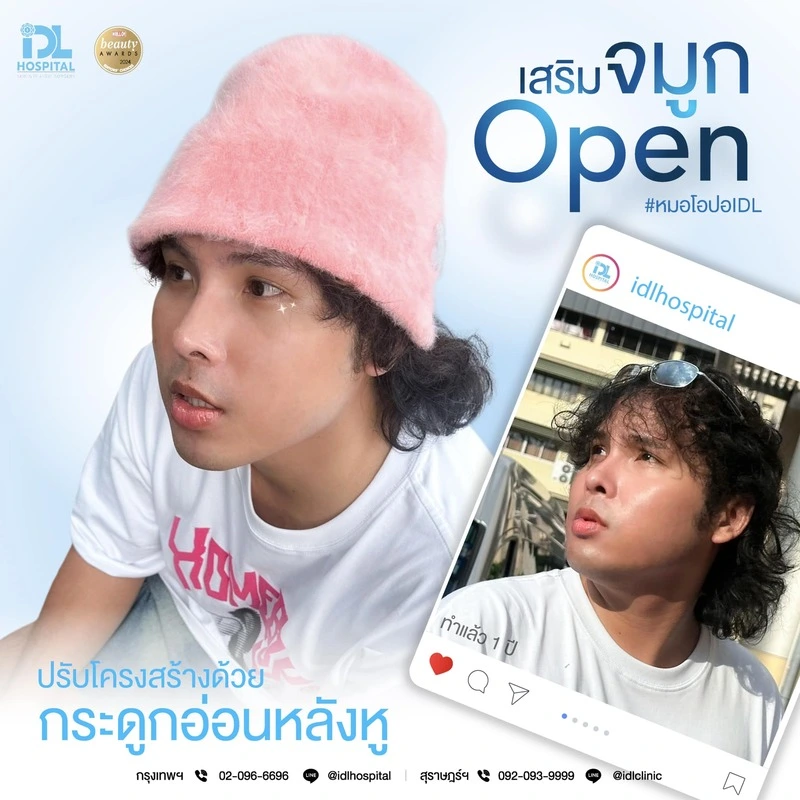 รีวิว เสริมจมูก Open IDL